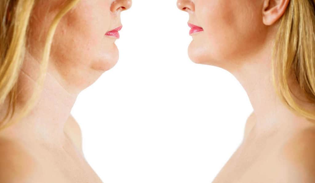 Double Chin treatment Harlow before and after results