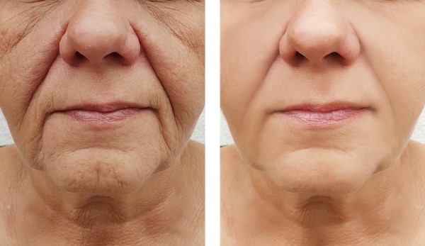 Learn more about Morpheus8 Treatment Harlow today!