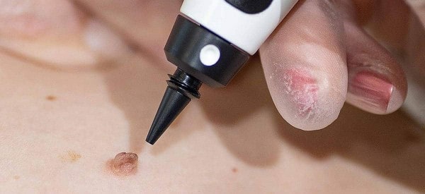 After Skin Tag Removal Harlow