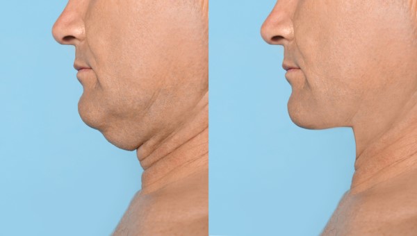Which Non-Surgical Treatments Work Best for Jowls and Loose Skin Harlow?