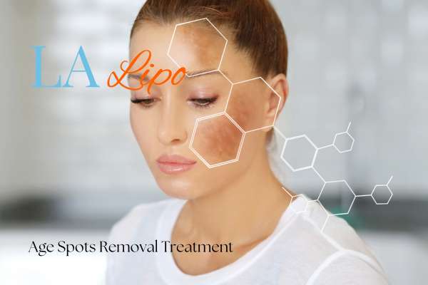 Age Spots Removal Treatment