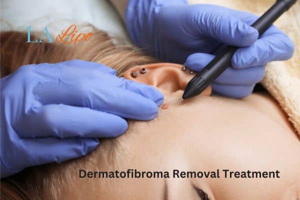 Dermatofibroma Removal Treatment Harlow