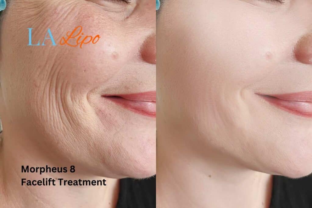Morpheus8 Treatment Harlow for flawless skin! Call us today!