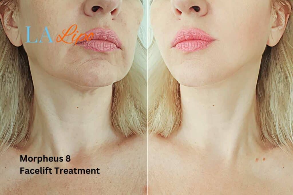 Turn back time with Morpheus8 Treatment Harlow