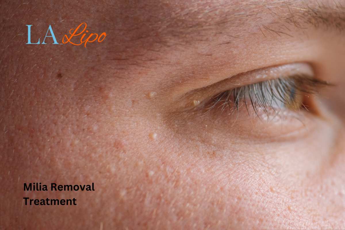 Cryopen Milia Removal: Is It the Easiest and Safest Option Harlow?