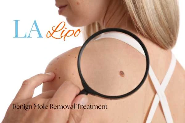 Woman having her inspection of blemish before mole removal Harlow