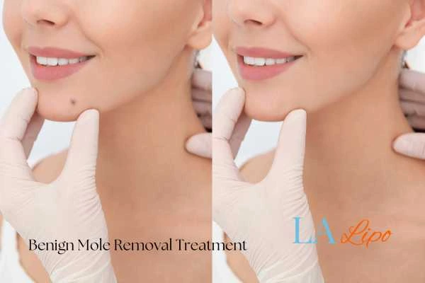 Before and after mole removal Harlow treatment