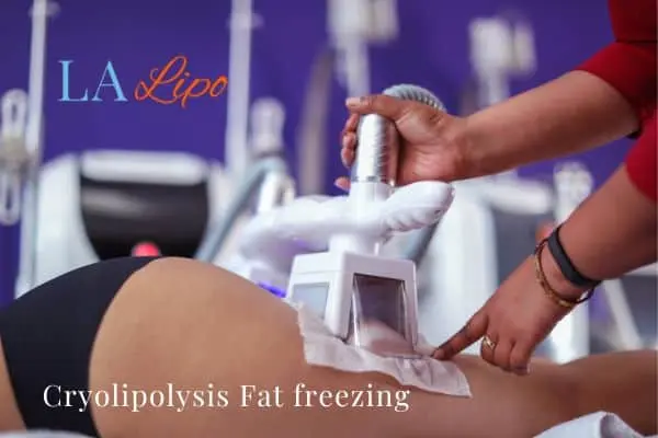 women getting fat freezing Harlow
