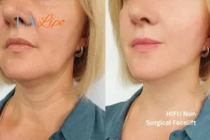 hi-fu for wrinkles Harlow before and after results