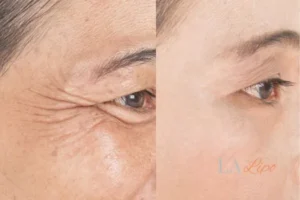 Before and after results of woman - HI-fu wrinkles reduction treatment Harlow