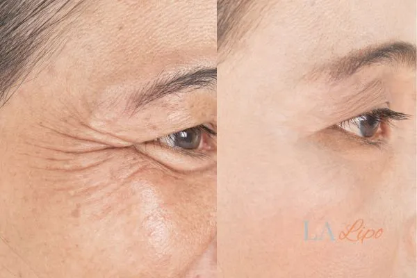 Before and after results of woman - HI-fu wrinkles reduction treatment Harlow