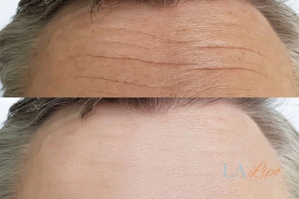 results of HIFU Harlow on mans forehead to help reduce lines and wrinkles