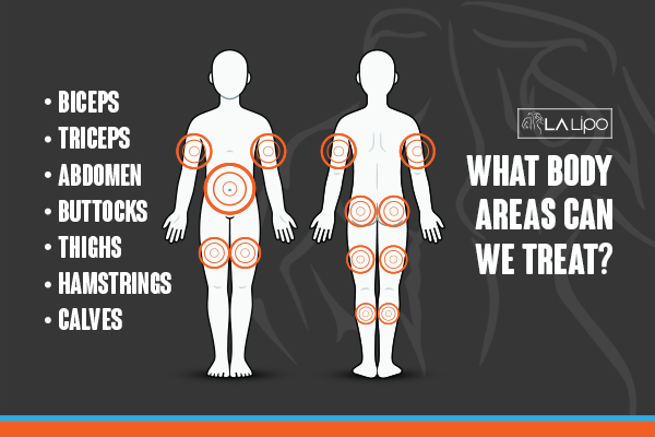 Graphic to show areas you can have LA-EMS Body Sculpting Harlow treatment.