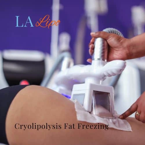 fat freezing - Cryolipolysis Harlow