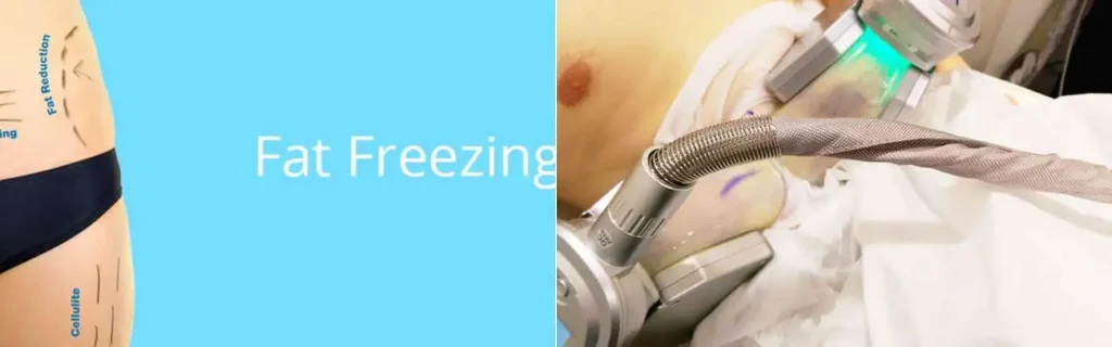 Fat freezing Harlow on multiple areas of the body
