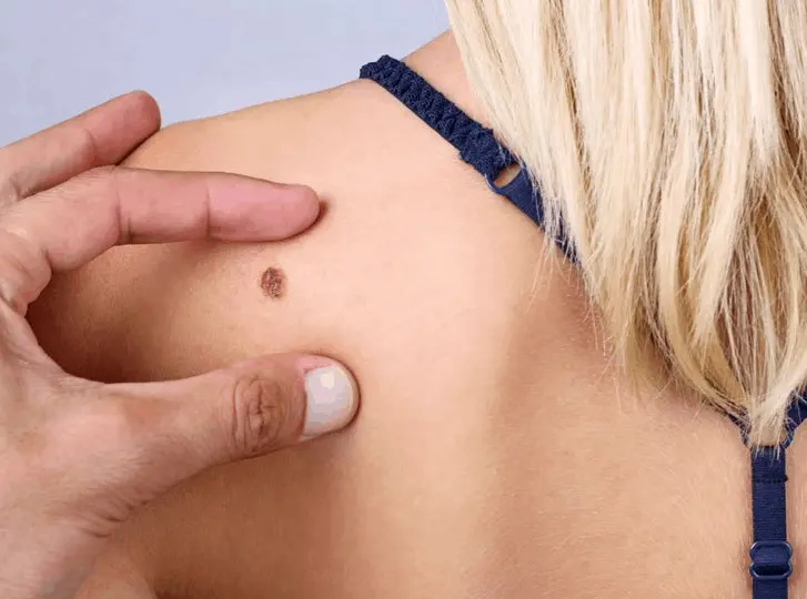 woman having mole removal Harlow consultation before treatment.