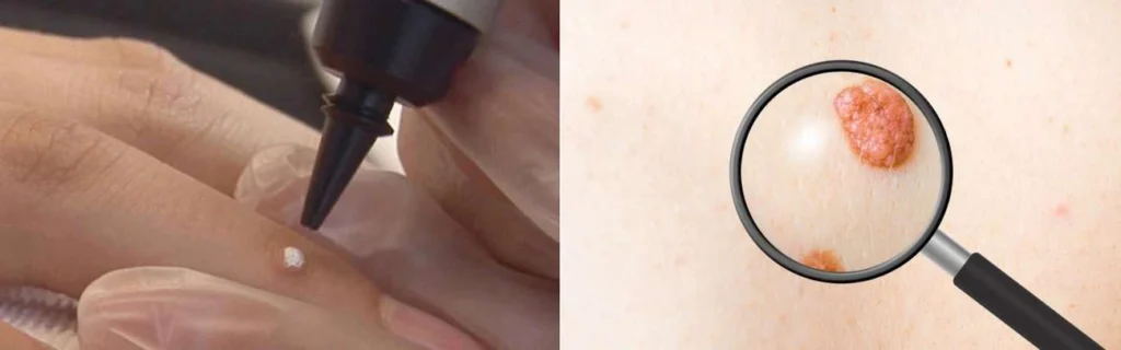 Person getting moles removed with cryopen Harlow
