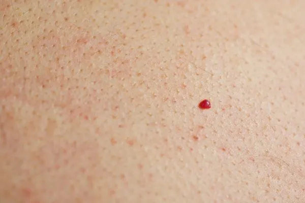 close up of a cherry angioma Harlow