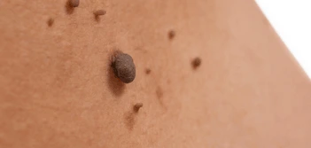 image of a skin tag Harlow