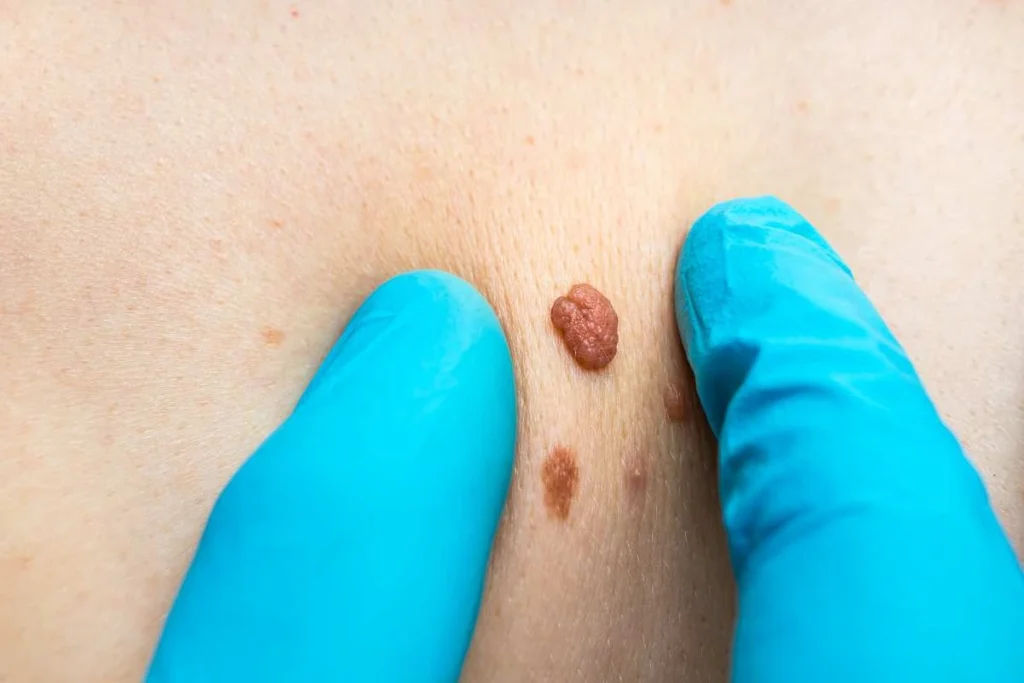 Consultant examining a skin tag Harlow