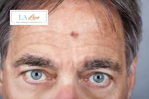 Solar Lentigo Removal Harlow image of man with mark on his forehead