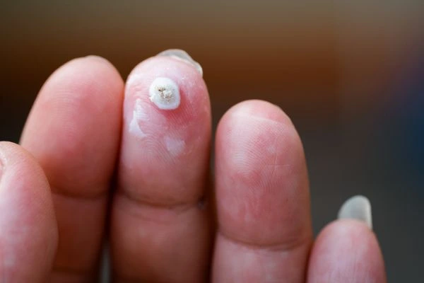 wart on person finger - cryotherapy to treat from LA LIPO Harlow