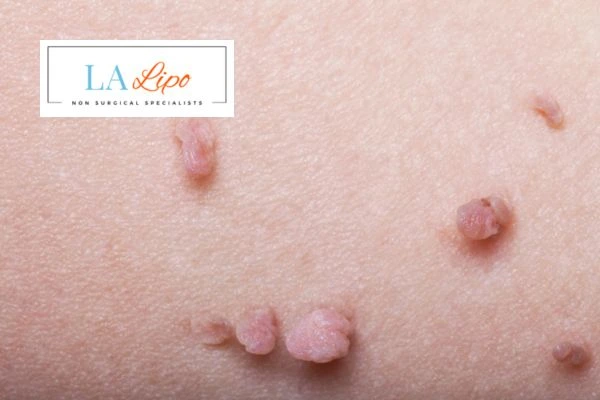 Does cryopen skin tag removal Harlow hurt? Find out now call our team today!