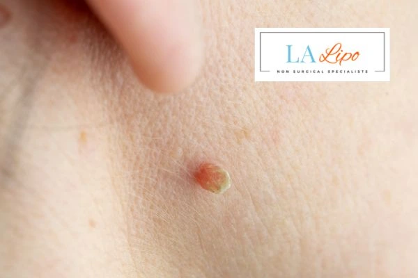Book skin tag removal Harlow today speak to our team now!