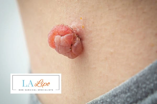 Interested in skin tag removal Harlow? Concerned about the pain? Find out more today!