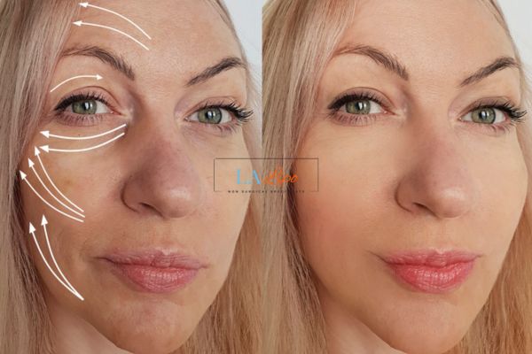Morpheus 8 results Harlow face lift.