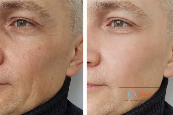 See the amazing results of Morpheus8 Treatment Harlow!