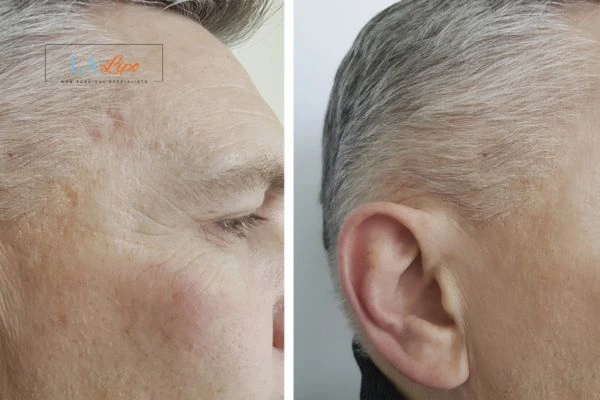 Mens Before & After Morpheus 8 Results Harlow