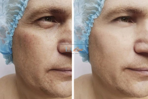 Before and after Morpheus 8 Results Harlow