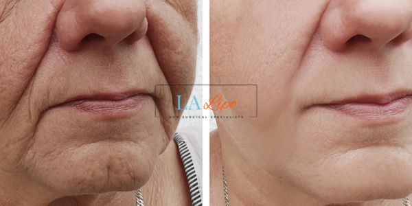 Older lady deeper wrinkle reduction - LA LIPO Morpheus 8 Results Harlow