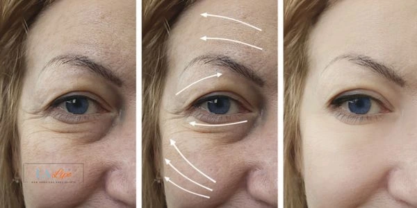 Amazing eye lift Morpheus 8 results Harlow