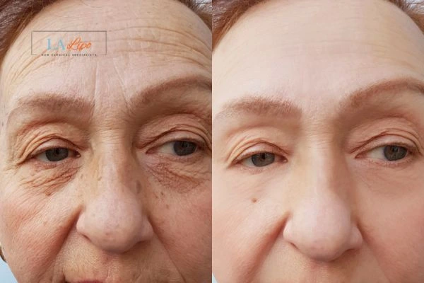 The powerful benefits of Morpheus8 Treatment Harlow - Call Our team today!