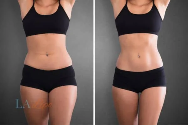 before and after results of non-surgical treatment to help a woman's body image and mental health Harlow