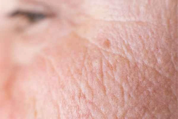 close up picture of a woman's face showing an age spot Harlow