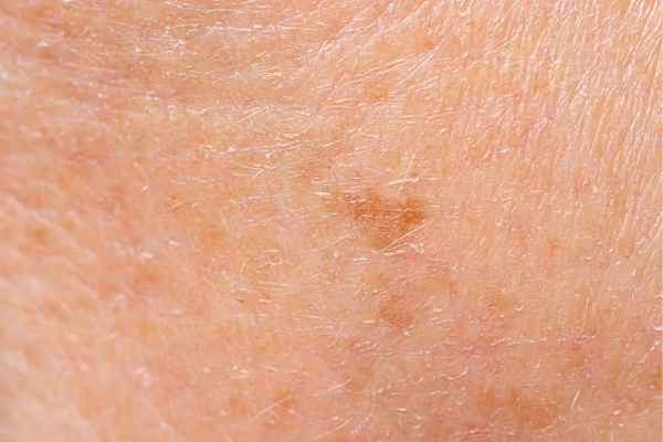 close up picture of age spots Harlow
