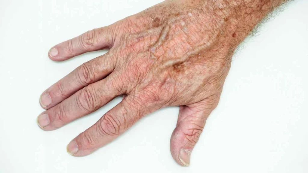 Male hand showing age spot Harlow