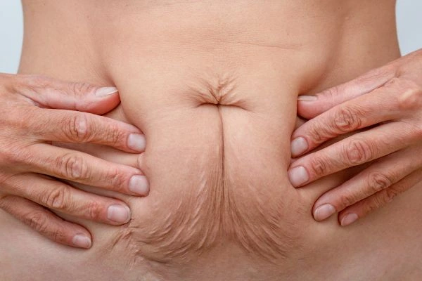 Image of a woman's stomach with loose skin - example of skin tightening Harlow options