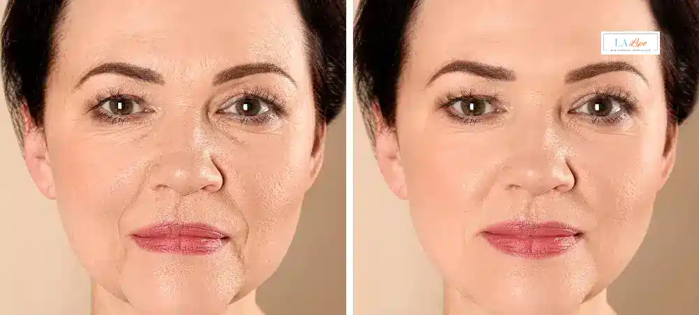 How Long Does It Take to See Results and How Long Do They Last Harlow?