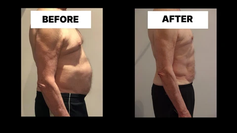 What Symptoms Can Diastasis Recti Cause in Men? Weak Core, Back Pain and Poor Posture Harlow